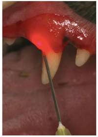 Parodontalbehandlung - Laser